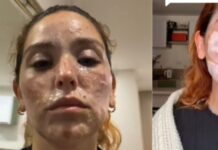 Una mujer sufre graves quemaduras en el rostro y cuello al explotarse un buñuelo durante su preparación