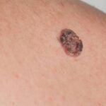 El cáncer de piel, uno de los más frecuentes en el Eje Cafetero